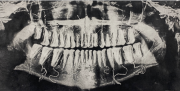 X-Ray image of teeth, with wires holding the teeth in place at the roots.